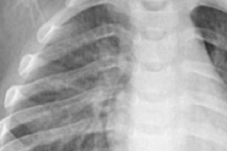 A chlamydia pneumoniae gyors kimutatása: megbízható és hatékony