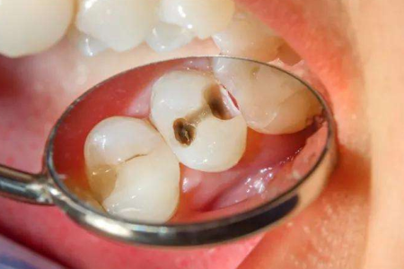 A Babio elindítja a fejlett caries dúsító közeget